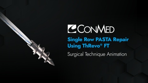 Single Row PASTA Repair Using ThRevo® FT