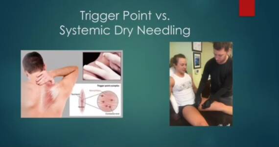 Dry needling
