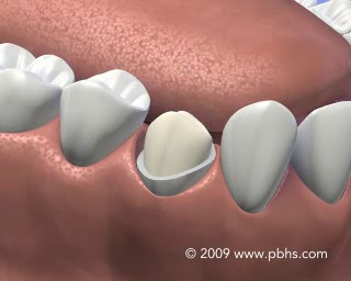 Dental Crowns