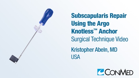 Dr. Abeln - Subscapularis Repair Using the Argo Knotless® Anchor