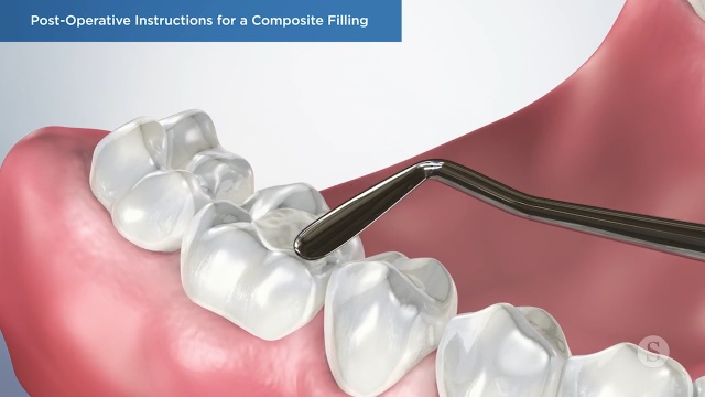 A Guide to the Composite Filling Procedure