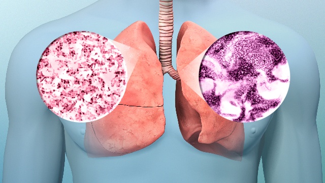 What to Expect After Chemotherapy for Lung Cancer