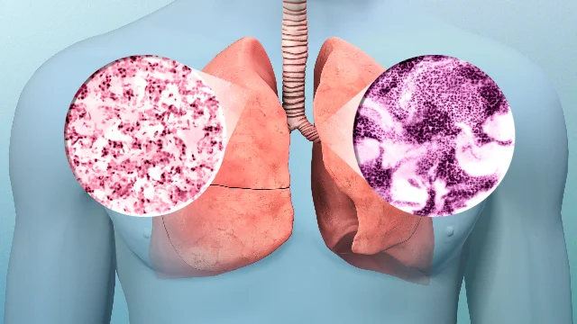 Lung Neoplasms 