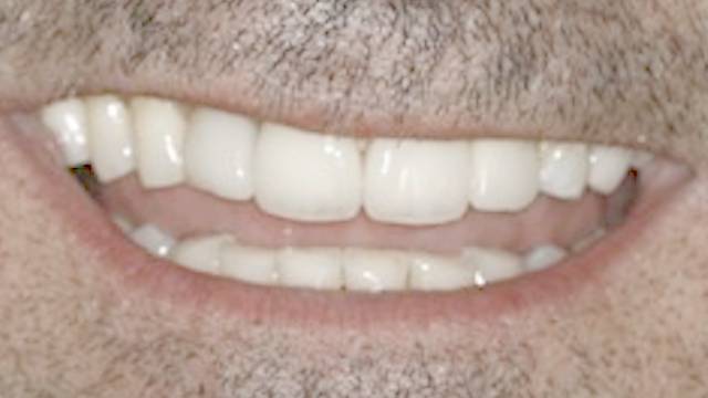 Before after Veneers