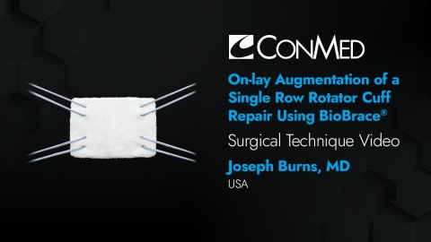 Dr. Burns - On-lay Augmentation of a Single Row Rotator Cuff Repair using BioBrace®
