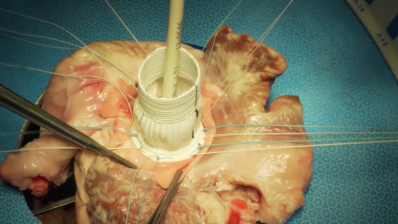 Dr. Glenn Barnhart: On-X Ascending Aortic Prosthesis Implantation