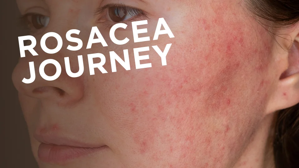 Rosacea Journey with a Skin Expert | Testimonial