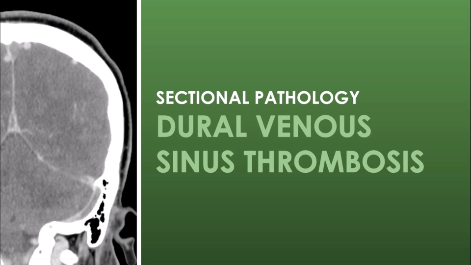CT Dural Venous Sinus Thrombosis | Video Lesson | Clover Learning