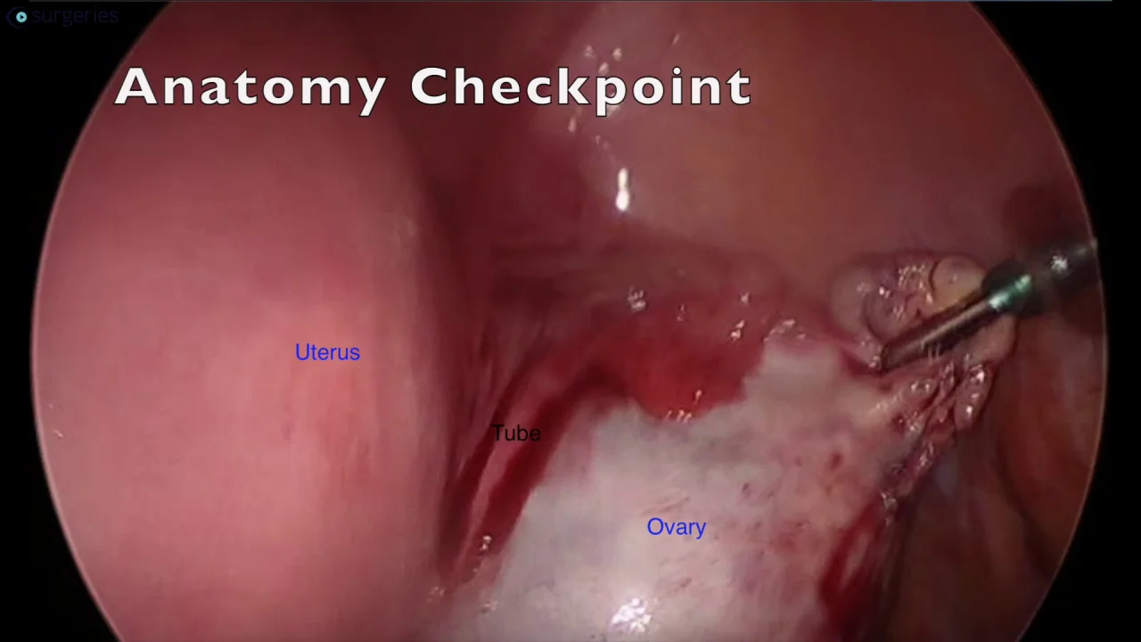 Laparoscopic oophorectomy - Mayo Clinic