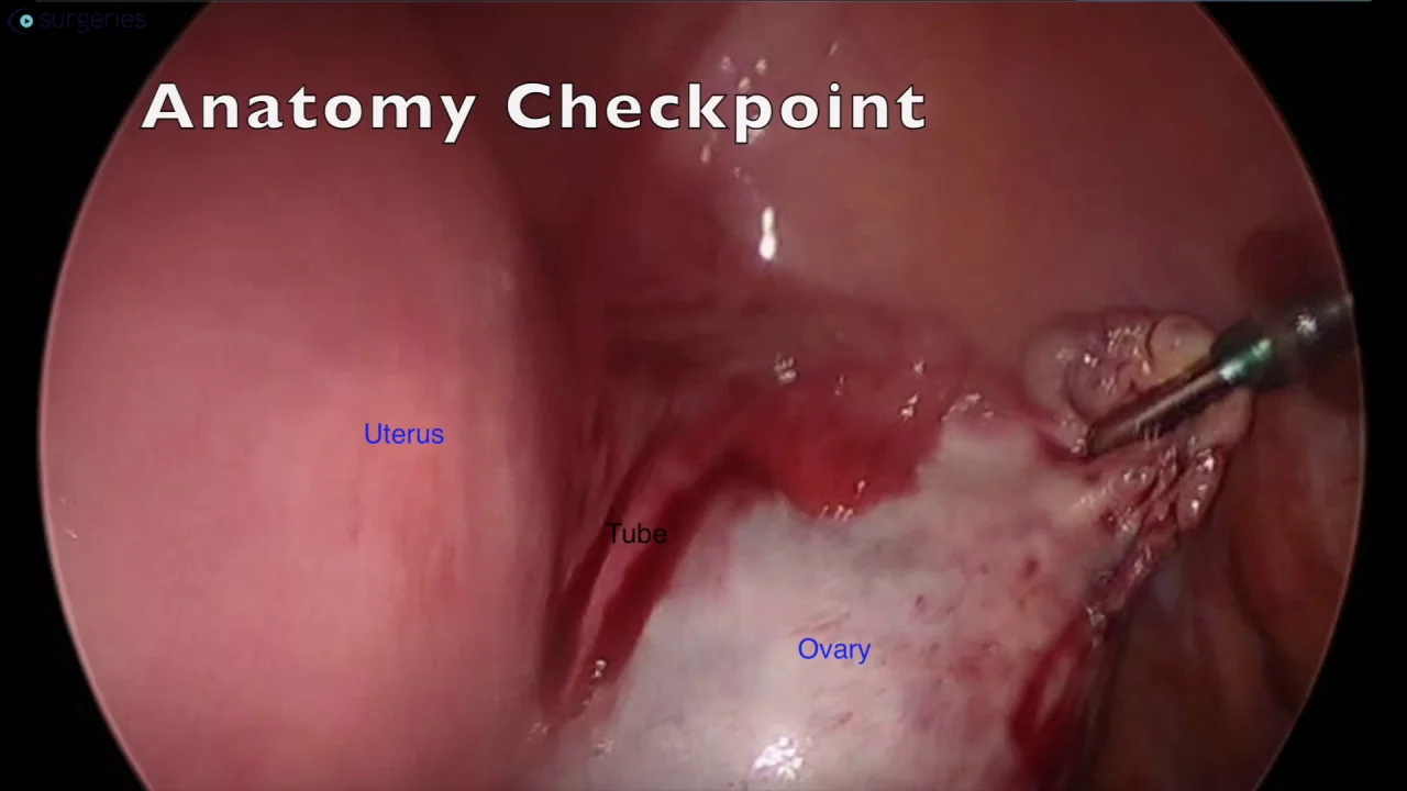 Laparoscopic Right Salpingo-oophorectomy in a patient at 17 weeks