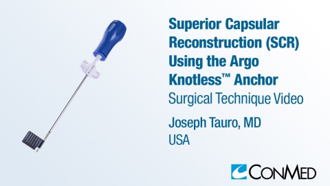 Dr. Tauro -  Superior Capsular Reconstruction (SCR) Using the Argo Knotless® Anchor