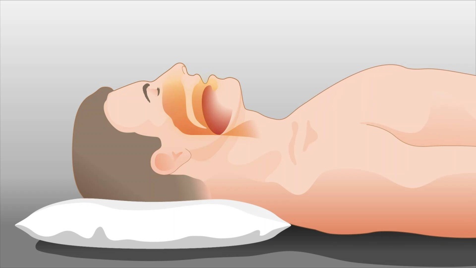 5 Ways to Cure Sleep Apnea - wikiHow