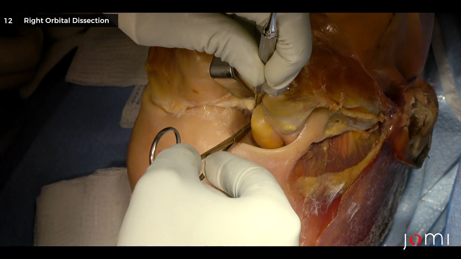 Video コロナルアプローチ(死体) | Journal of Medical Insight