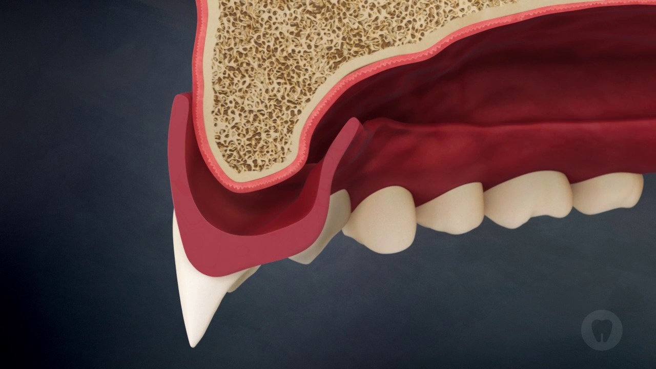 Implant: Ridge Resorption And Unstable Denture