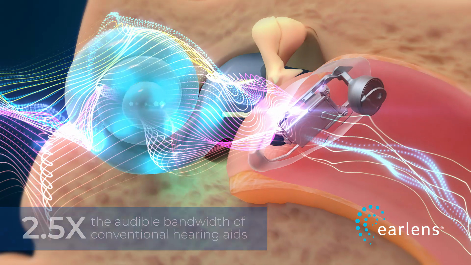 The Only Nonsurgical Lens - Earlens The Only Nonsurgical Lens - Earlens