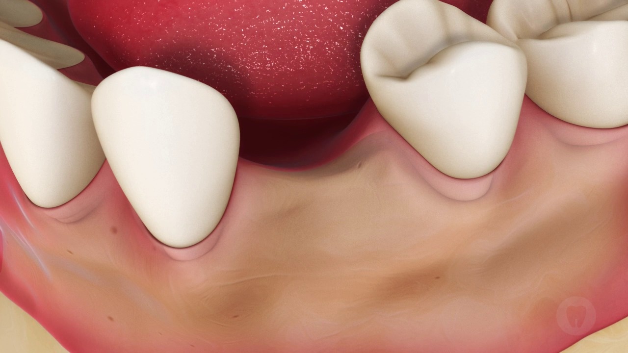 Tooth Loss: Resulting Bone Loss