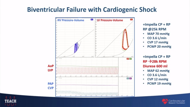 Intra-Aortic Balloon Pump for High-Risk Percutaneous Coronary Intervention