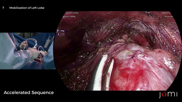 What You Need to Know about Mental Nerve Surgical Anatomy for Transoral  Thyroidectomy