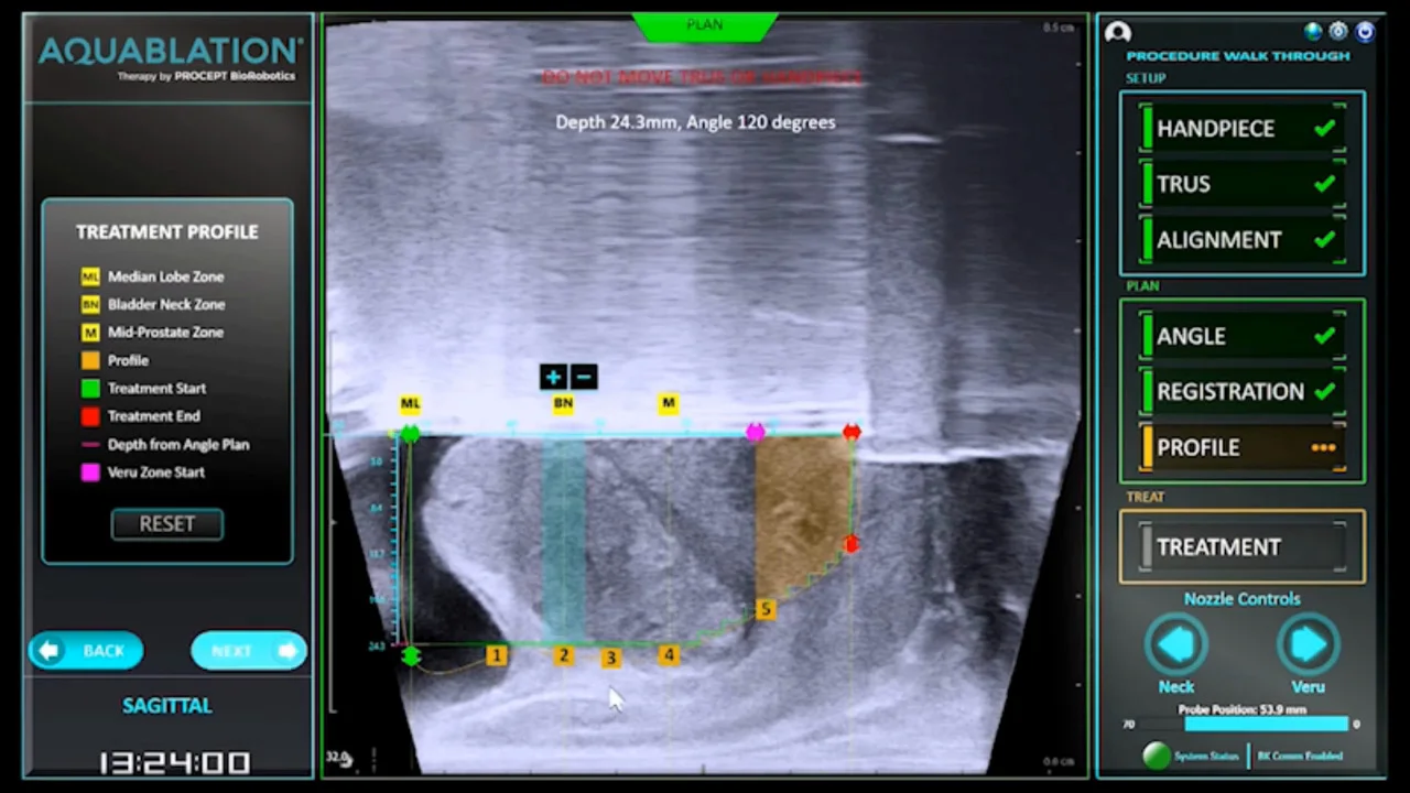 Deaconess - Aquablation Therapy: Surgical Treatment for BPH (enlarged  prostate) | Deaconess Clinic Urology