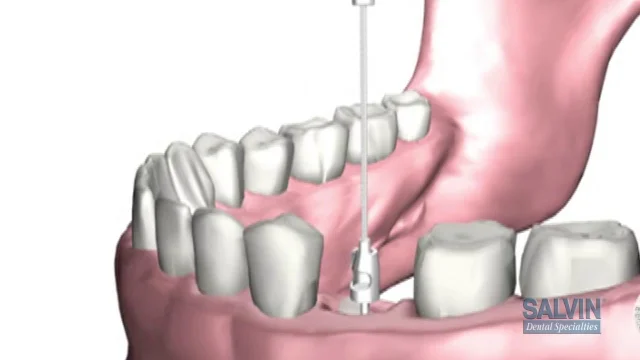 Salvin Benex Atraumatic Kit – Salvin Dental Specialties