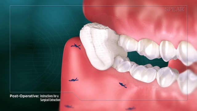 Instructions After Tooth Removal Tooth Extraction Care Instructions