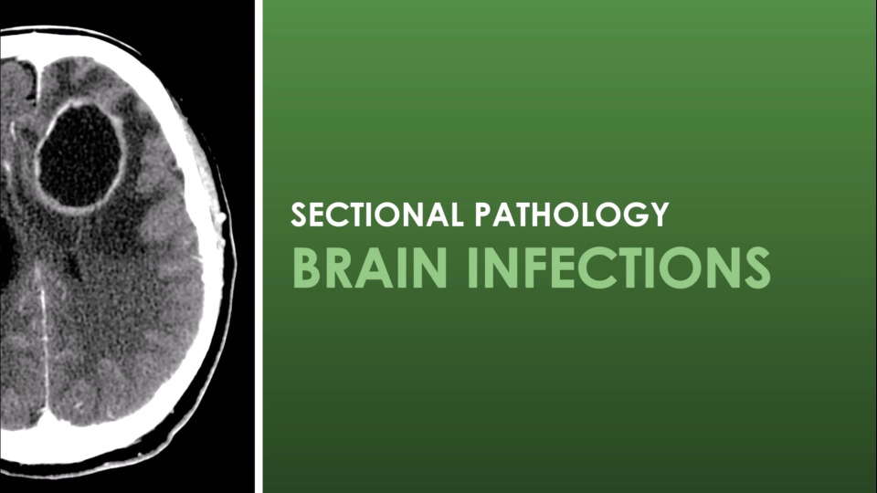 CT Brain Infection | Video Lesson | Clover Learning