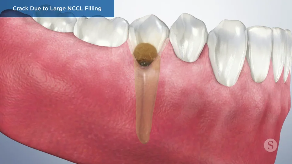 Noncarious Cervical Lesions: Morphology And Progression,, 46% OFF