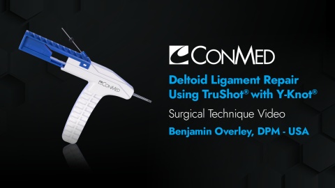 Dr. Overley - Deltoid Ligament Repair Using TruShot® with Y-Knot®