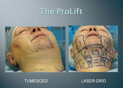 Thumbnail for The ProLift – Advanced Technology and Technique for Achieving Professional Facelift Results With Minimal Downtime