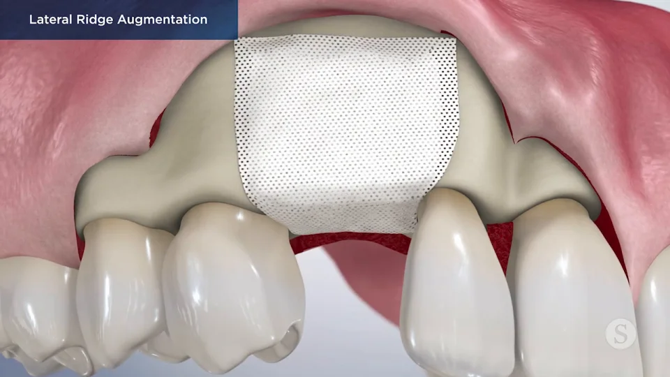 SP190 Lateral Ridge Augmentation