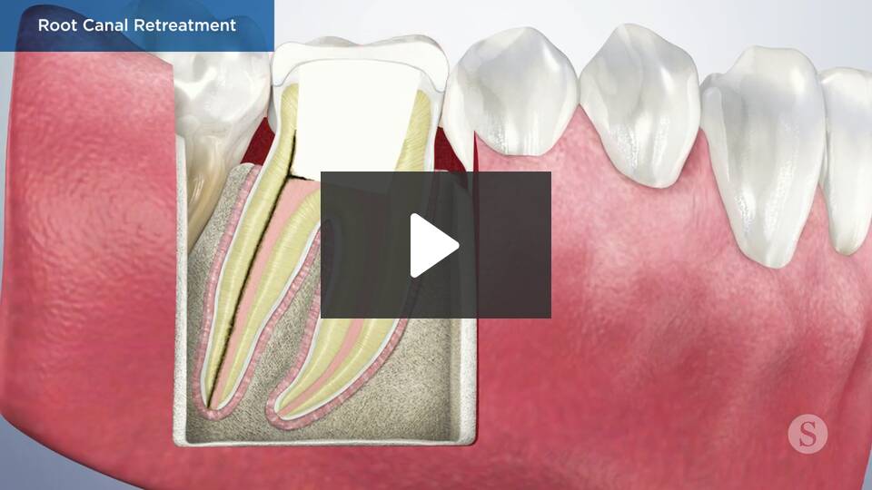 Endodontics Colorado Springs | Elevation Endodontics - root canal retreatment