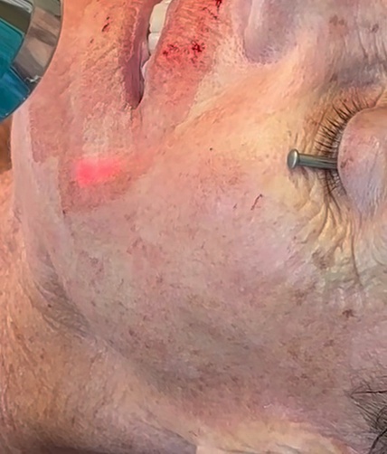 Video of the laser skin resurfacing procedure