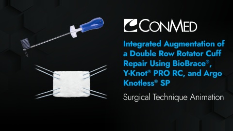 Integrated Augmentation of Double Row Rotator Cuff Repair Using BioBrace®, Y-Knot® PRO RC, and Argo Knotless® SP