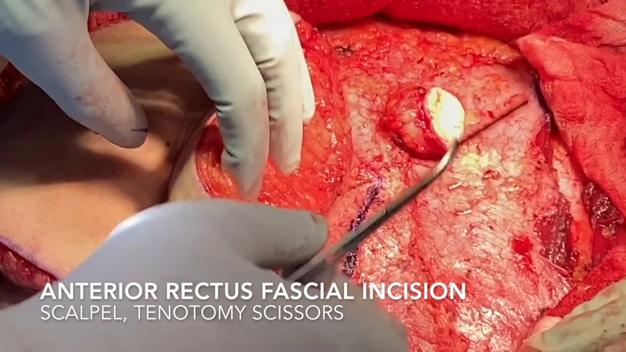 Deep Inferior Epigastric Perforator Flap: Abdominal Flap Dissection