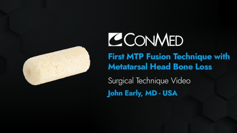 Dr. Early - First MTP Fusion Technique with Metatarsal Head Bone Loss