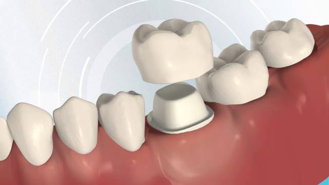 ADA video discussing dental crowns