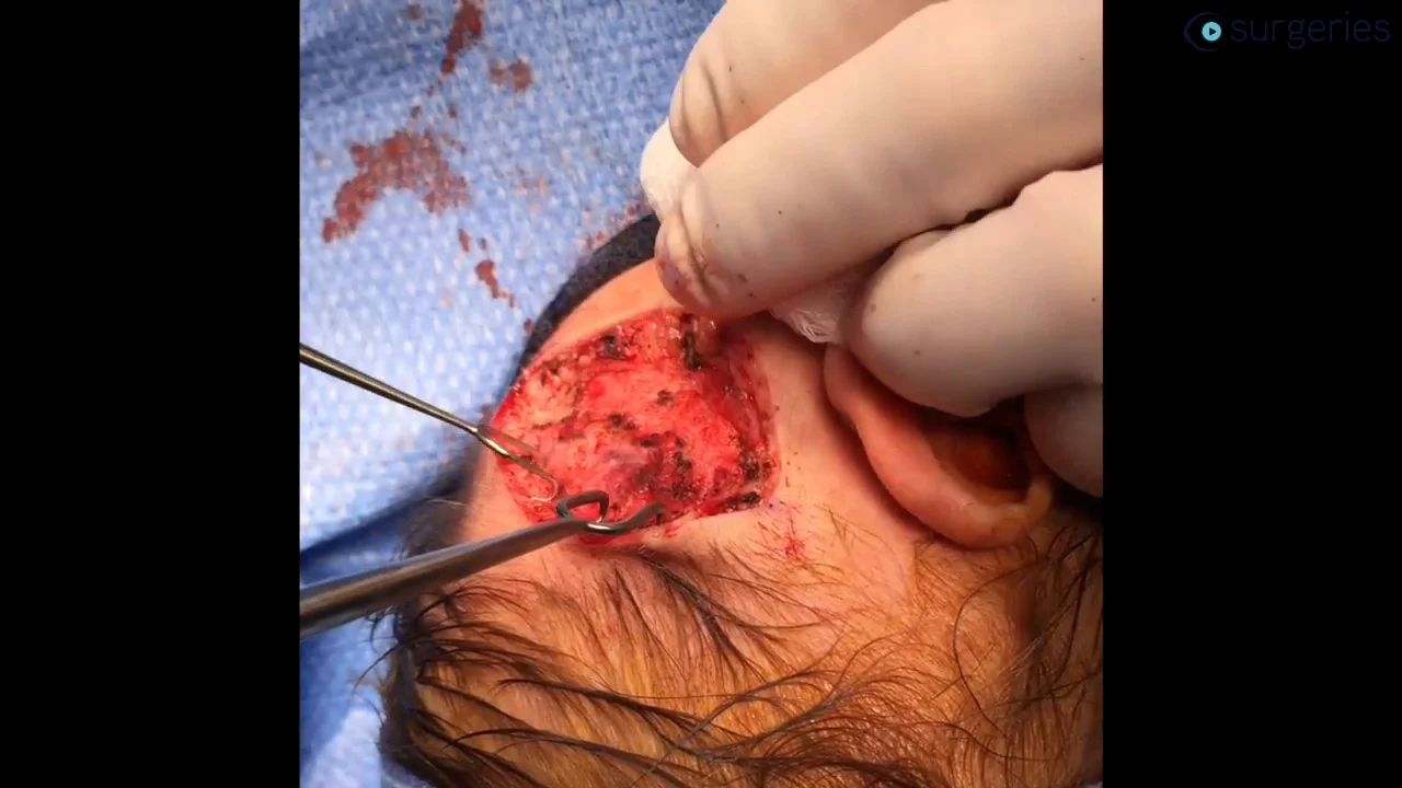 Excision of Scalp Congenital Hemangioma