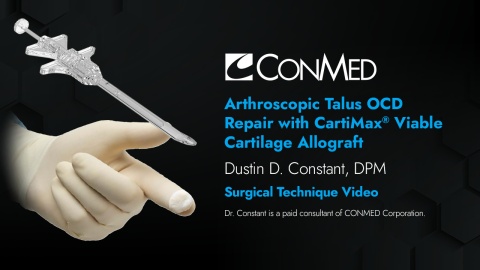 Dr. Constant - Arthroscopic Talus OCD Repair with CartiMax® Viable Cartilage Allograft - Surgical Technique Video