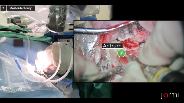 mastoidectomy types