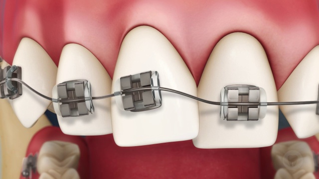 Invisalign Vs Fixed Braces - Brucegate Dental Practice