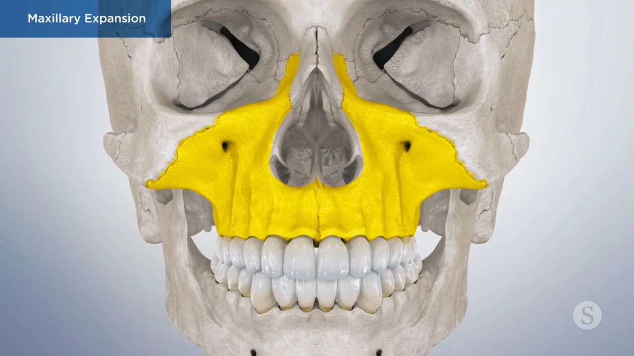 Maxillary Skeletal Expansion (MSE); Miniscrew Assisted Rapid