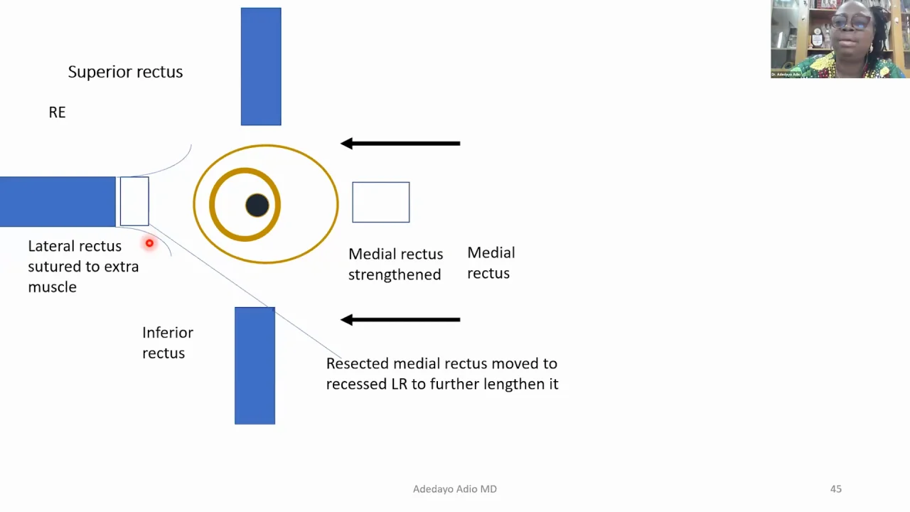 Lecture: True Ocular Muscle Transplantation to Treat Extra Large Horizontal Strabismus | Cybersight Lecture: True Ocular Muscle Transplantation to Treat Extra Large Horizontal Strabismus | Cybersight
