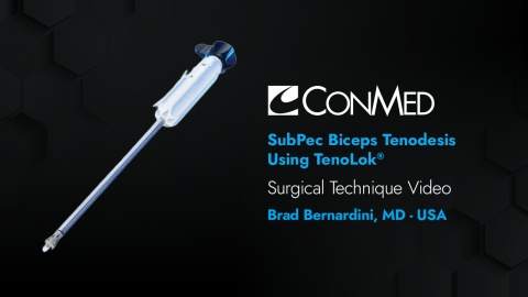Dr. Bernardini - SubPec Biceps Tenodesis Using TenoLok®