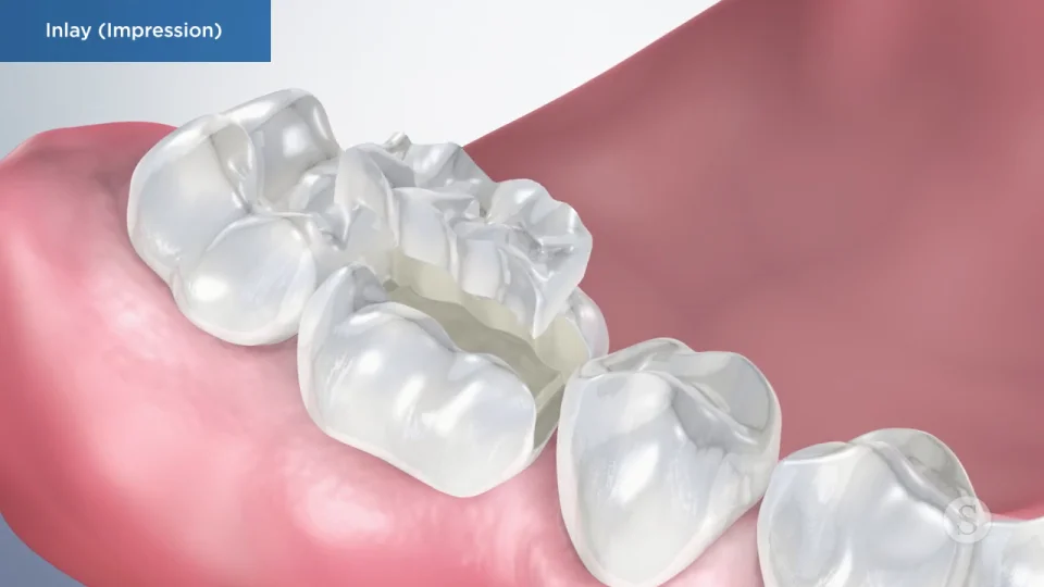 Dental Restorations | Fillings | Inlays And Onlays | Tooth Crowns