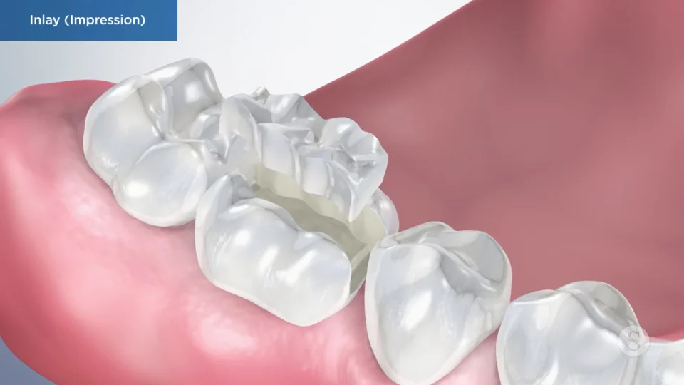 Dental Restorations | Fillings | Inlays And Onlays | Tooth Crowns Dental Restorations | Fillings | Inlays And Onlays | Tooth Crowns