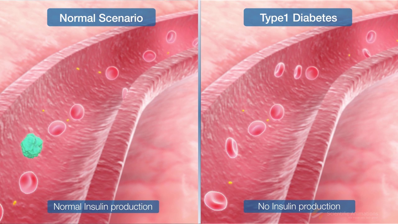 3D Medical Animation – Type 1 Diabetes Mellitus