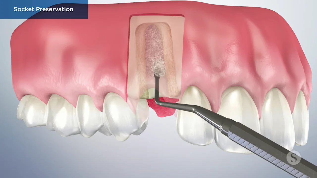 Removal of dental implants: review of five different techniques