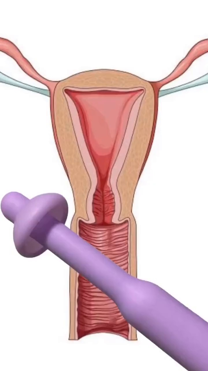 Impregnator insemination kit video