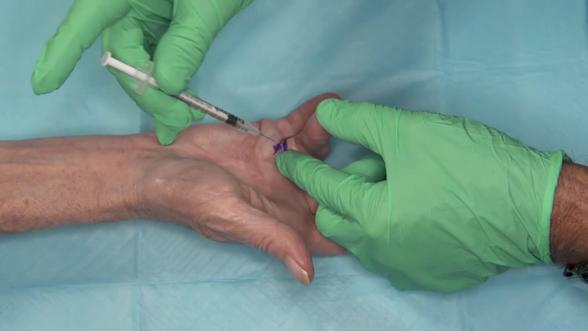 Gary Pess, MD: 2-joint procedure fourth finger 32° MP joint and 72° PIP joint contracture video thumbnail
