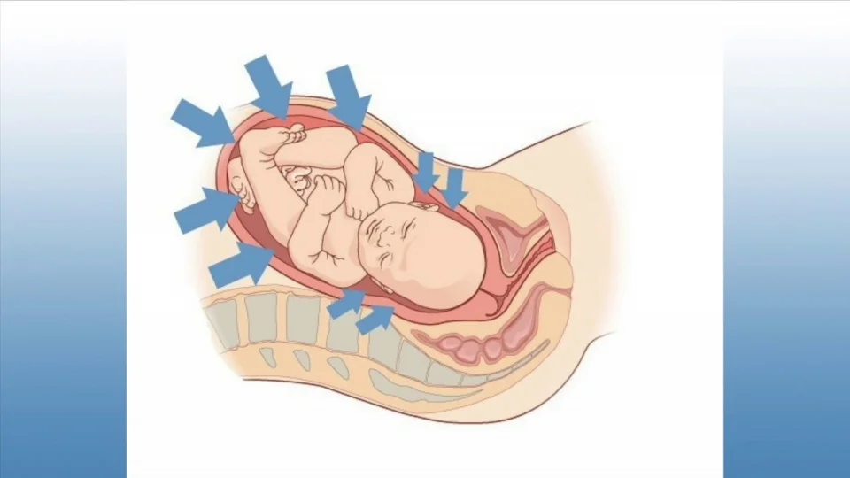 Five Misperceptions About Hypoxic-Ischemic Encephalopathy (HIE)